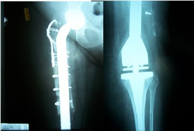 Most® Total Femoral Replacement (Implant 429)